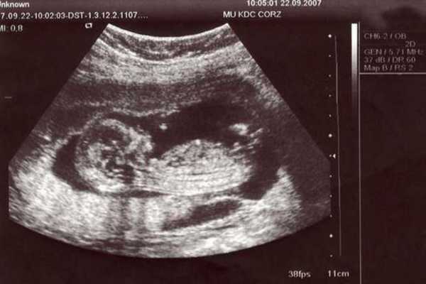 怀孕36周怎么看B超数据判断正不正常？