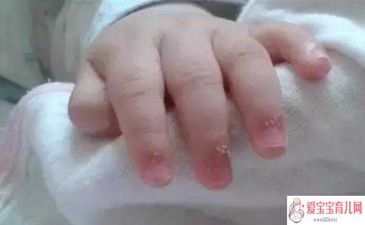 宝宝手上长肉刺是因为缺乏营养吗宝宝手指上长倒刺是什么原因