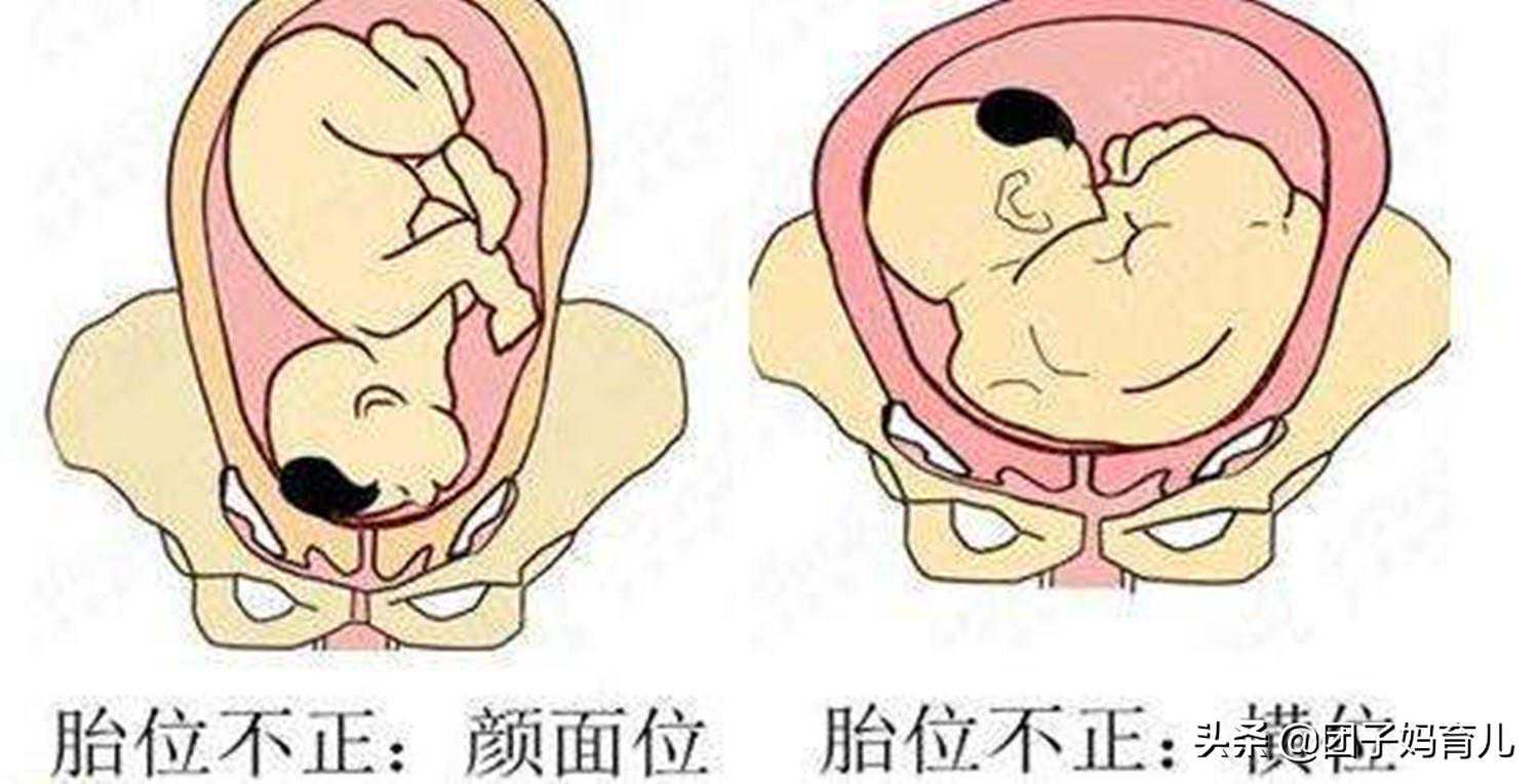 产妇不符合顺产条件，丈夫却阻拦医生手术，哪些情况需要剖腹产？
